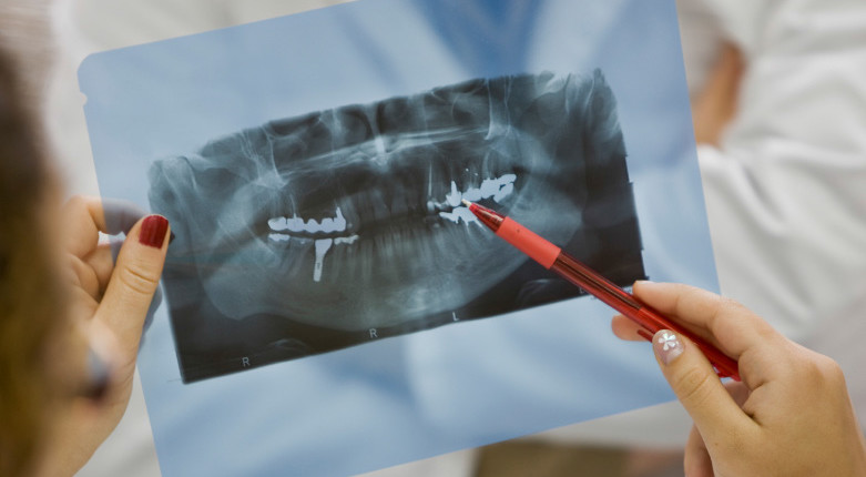 Zahnversicherung, Krankenzusatzversicherung Zahn, Zahnzusatzversicherung